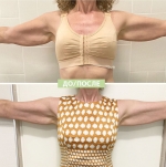 Процедура ультразвукового лифтинга Ulfit