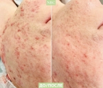 Лечение акне. Результат после первой процедуры в Natural Beauty Clinic
