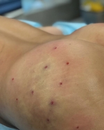 Ягодицы сразу после липофилинга