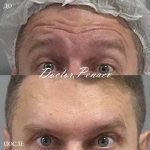 Пациентка доктора А.А. Пенаева до и после процедуры «Вечный Ботокс»